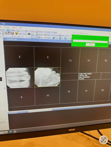 Computer screen displaying medical imaging software for Aribex Nomad Pro Handheld Dental Intraoral System