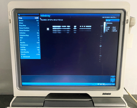 Picture of the screen for the Mindray DP-50 Digital Ultrasound System with 75L38EA Linear Transducer 