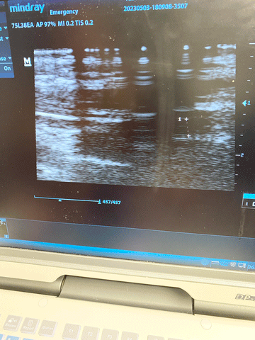 Picture of the screen for the Mindray DP-50 Digital Ultrasound System with 75L38EA Linear Transducer 