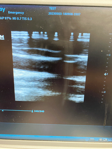 Picture of the screen for the Mindray DP-50 Digital Ultrasound System with 75L38EA Linear Transducer 