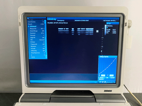 Picture of the screen for the Mindray DP-50 Digital Ultrasound System with 75L38EA Linear Transducer 