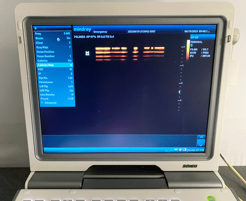 Picture of the screen for the Mindray DP-50 Digital Ultrasound System with 75L38EA Linear Transducer 