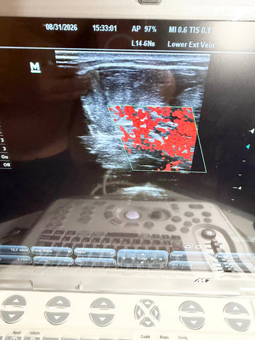 A handheld ultrasound machine with a screen showing a vascular Doppler reading in the lower extremity vein, photographed in a clinical setting with the control panel visible below.