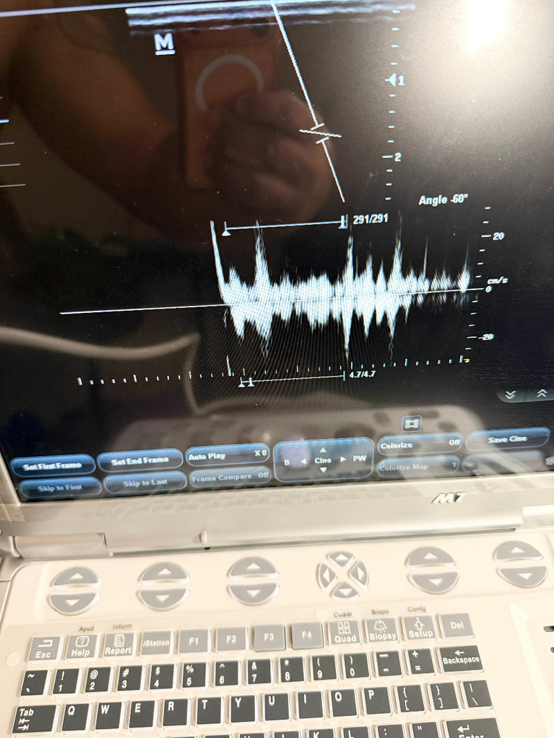 A close-up of a screen displaying an ultrasound waveform and angle measurement interface, with part of the keyboard visible below.