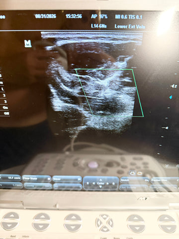 A close-up of an ultrasound machine screen showing a grayscale medical scan with measurement boxes and interface controls, photographed indoors with reflections on the monitor.