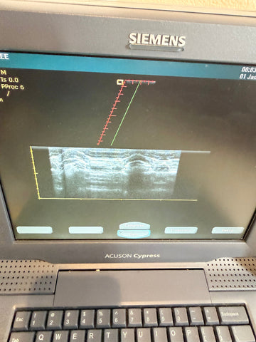 A Siemens Acuson Cypress ultrasound machine showing a grayscale ultrasound image on its screen, with a keyboard and control panel visible below.