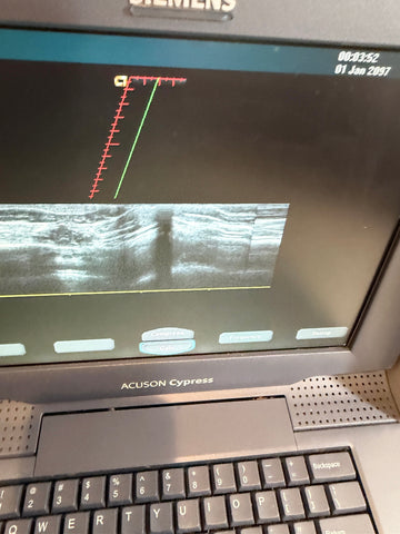 A close-up of a Siemens Acuson Cypress ultrasound machine showing a grayscale ultrasound image on its screen, with the keyboard and palm rest visible.