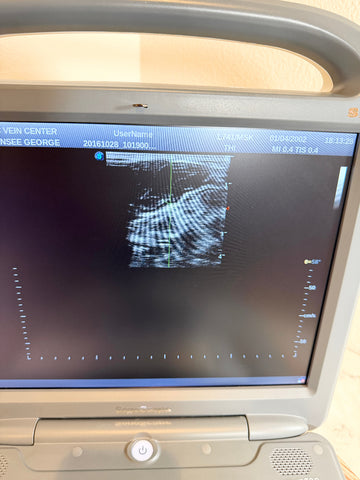 A Sonoscape ultrasound machine showing a grayscale medical scan on a dark screen, photographed indoors with part of the control panel and a beige surface visible around it.