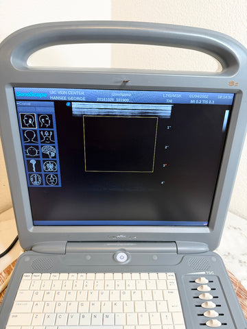 A Sonoscape ultrasound machine with a gray plastic housing, integrated handle, and keyboard, shown open and in use with its screen active.