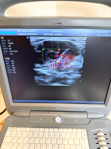 A portable Sonoscape ultrasound machine with a gray casing, cream-colored keyboard, and a screen displaying a medical scan.