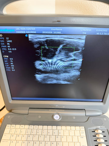 A portable Sonoscape ultrasound machine with a gray casing, cream-colored keyboard, and a screen displaying a blue and white medical ultrasound image. The brand logo 'SonicVision' is visible on the screen.