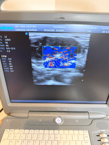 A Sonoscape ultrasound machine with a screen showing reading, photographed indoors on a beige surface.