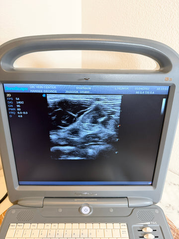 A portable Sonoscape ultrasound machine with a gray handle and console, showing a grayscale ultrasound image on its screen. The machine has a beige keyboard and control buttons on the right, photographed against a neutral indoor background.