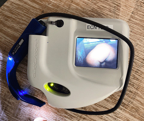 Picture of the screen for Verathon GlideScope Ranger Video Laryngoscope Monitor